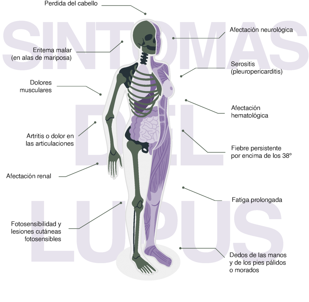 Sintomas de el Lupus